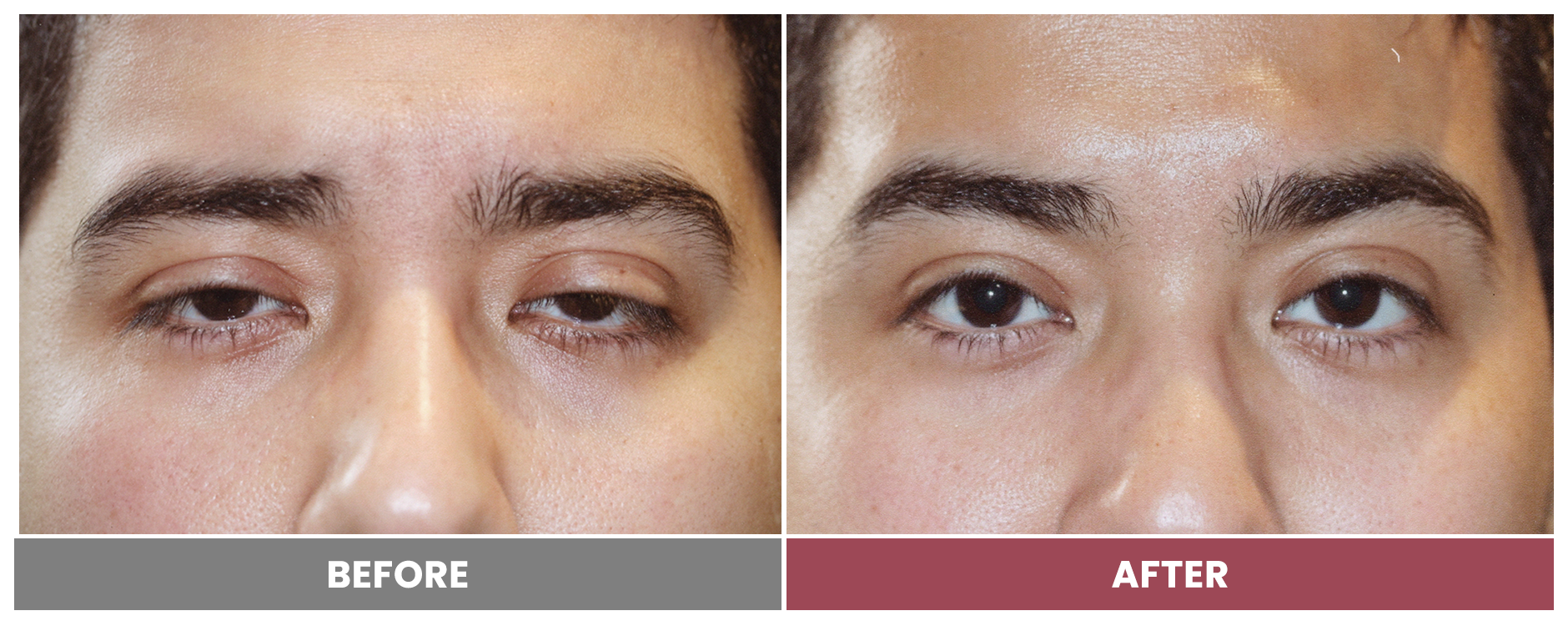 PTOSIS REPAIR - Case 31